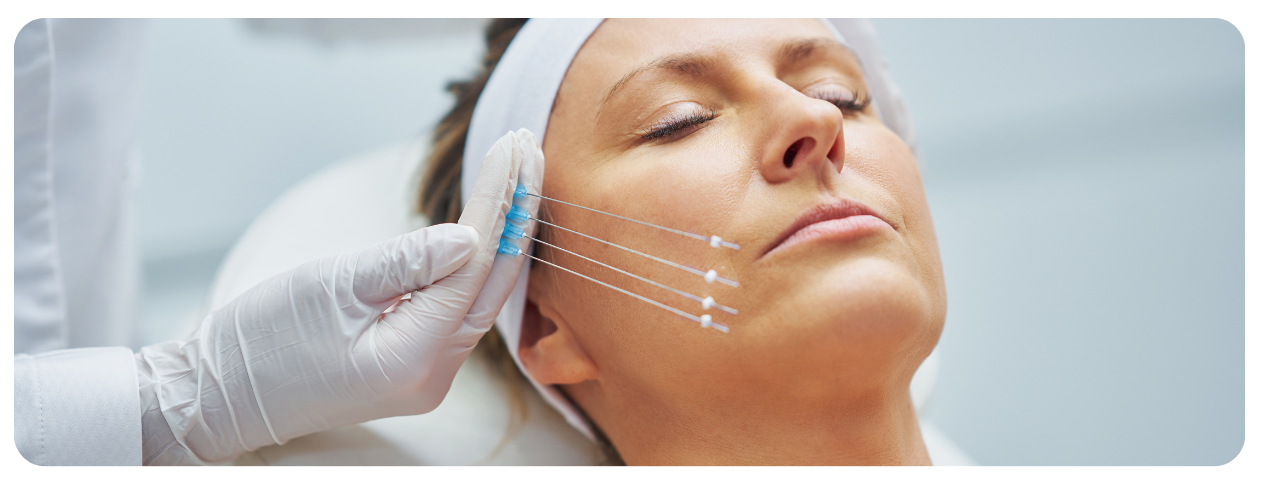 fios de bioestímulo de colágeno