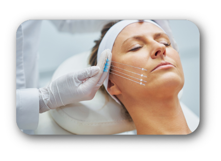 fios de bioestímulo de colágeno